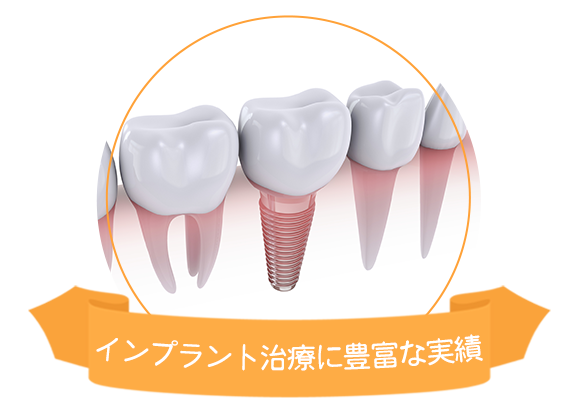 インプラント治療に豊富な実績